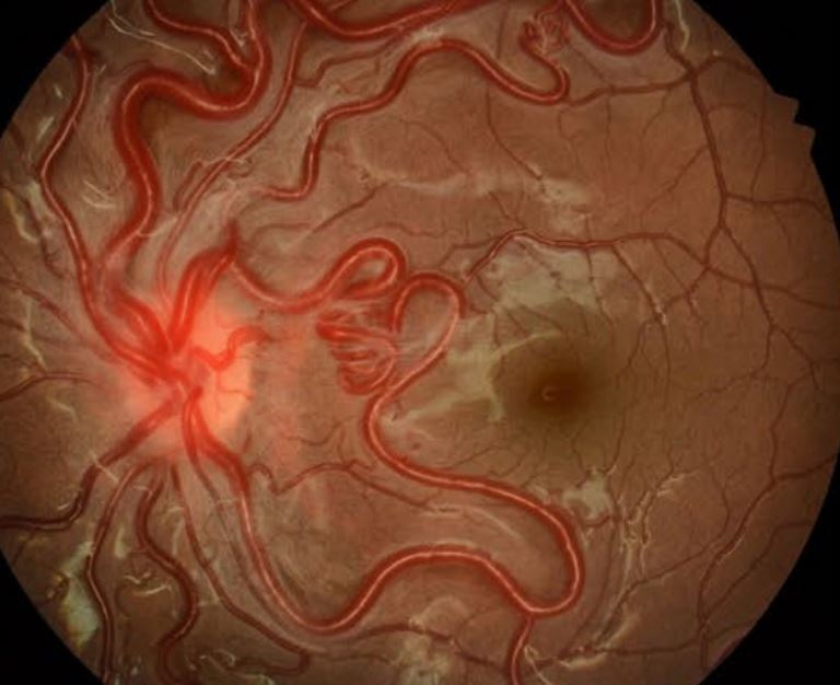 <p>Retinal Racemose Angioma