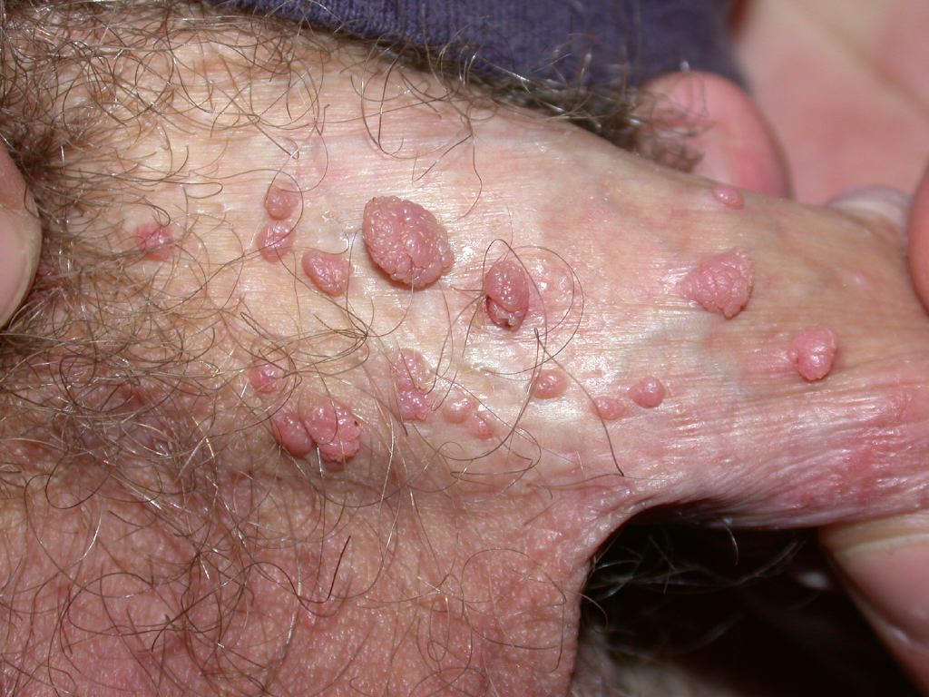 <p>Genital Warts, Male</p>