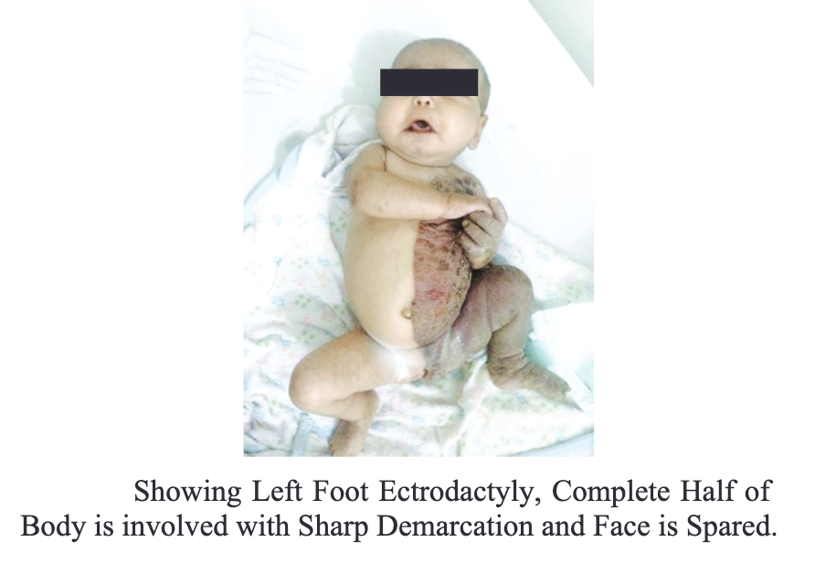 <p>Five-Month-Old-Girl With CHILD Syndrome