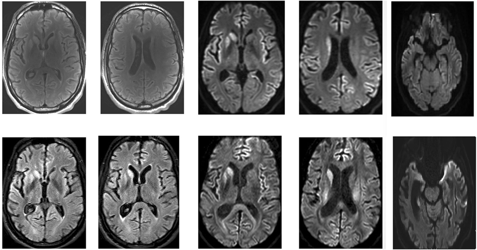 <p>Brain MRI of a Patient With Early-Stage Creutzfeldt-Jakob Disease