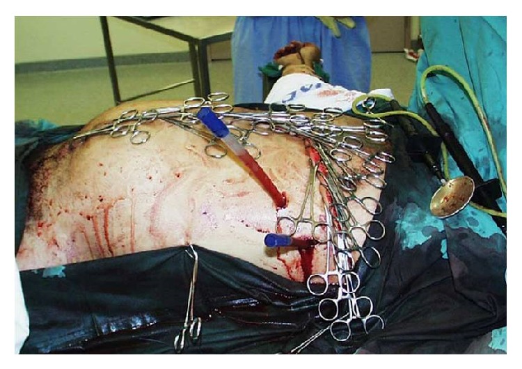 <p>Skin-Only Closure. Towel clips are placed into the skin to close the abdomen temporarily.</p>