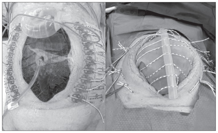 <p>Dynamic Closure of Open Abdomen. Installation of the ABRA<sup>&reg;</sup> system to the ABThera<sup>&reg;</sup>system.</p>