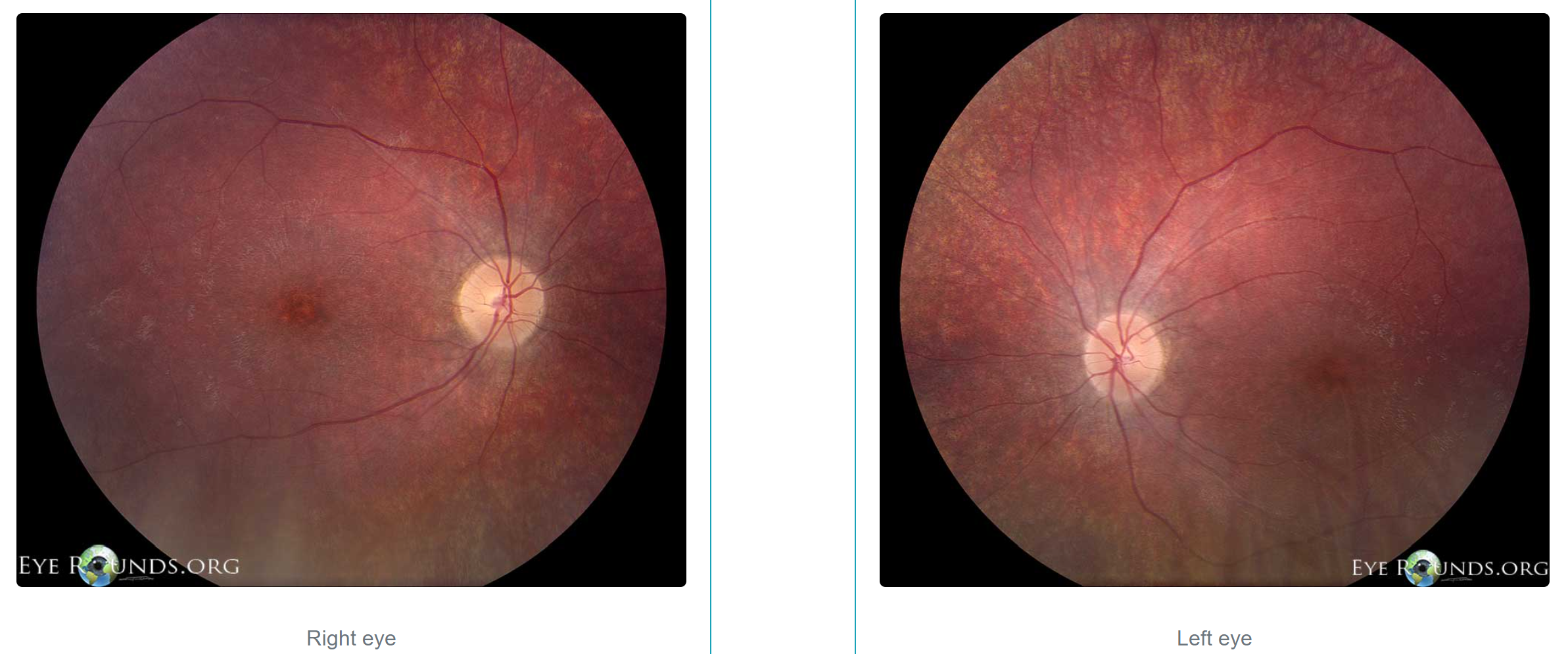 <p>Fundus Photos of Patient with Batten Disease