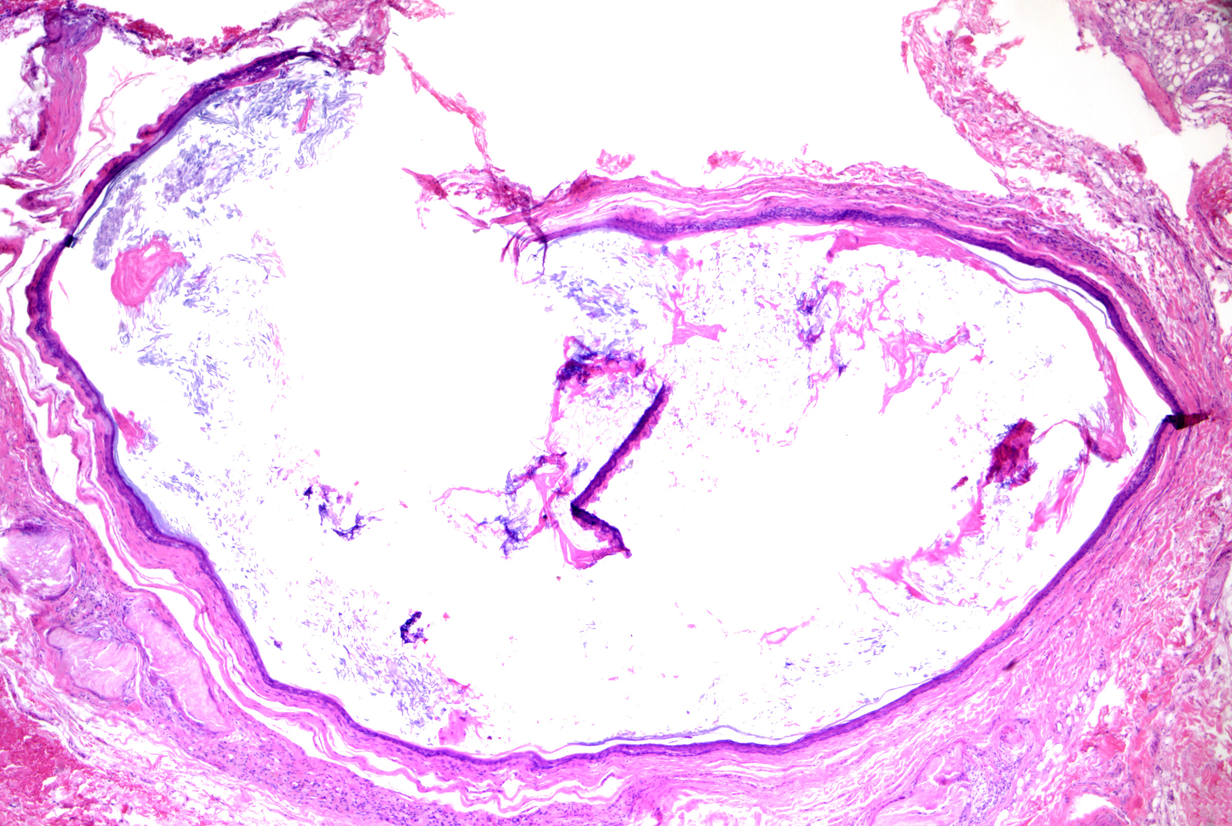 <p>Epidermoid Cyst. H&amp;E staining at 40x magnification.</p>