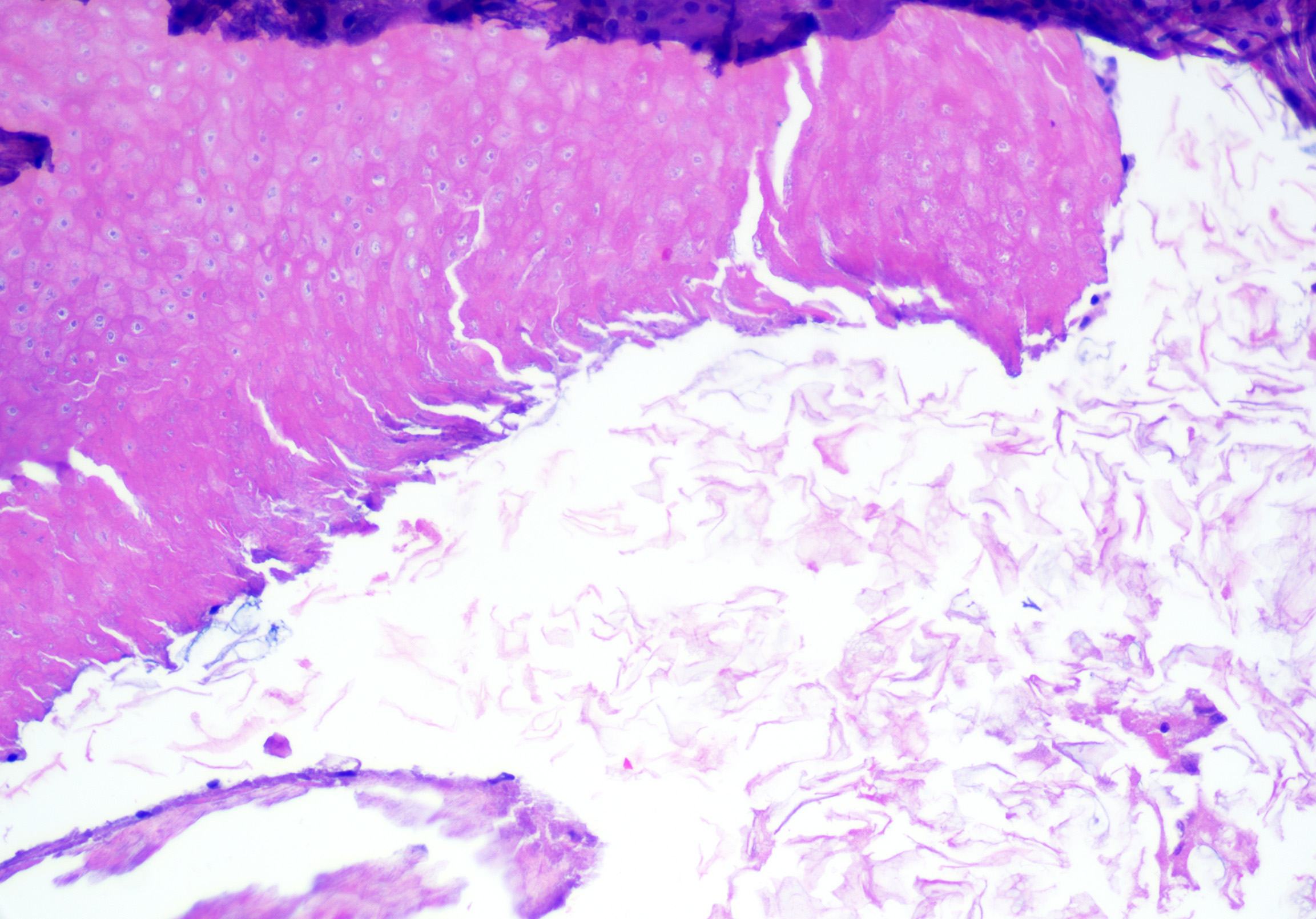 <p>Epidermoid Cyst With Pilomatrical Differentiation