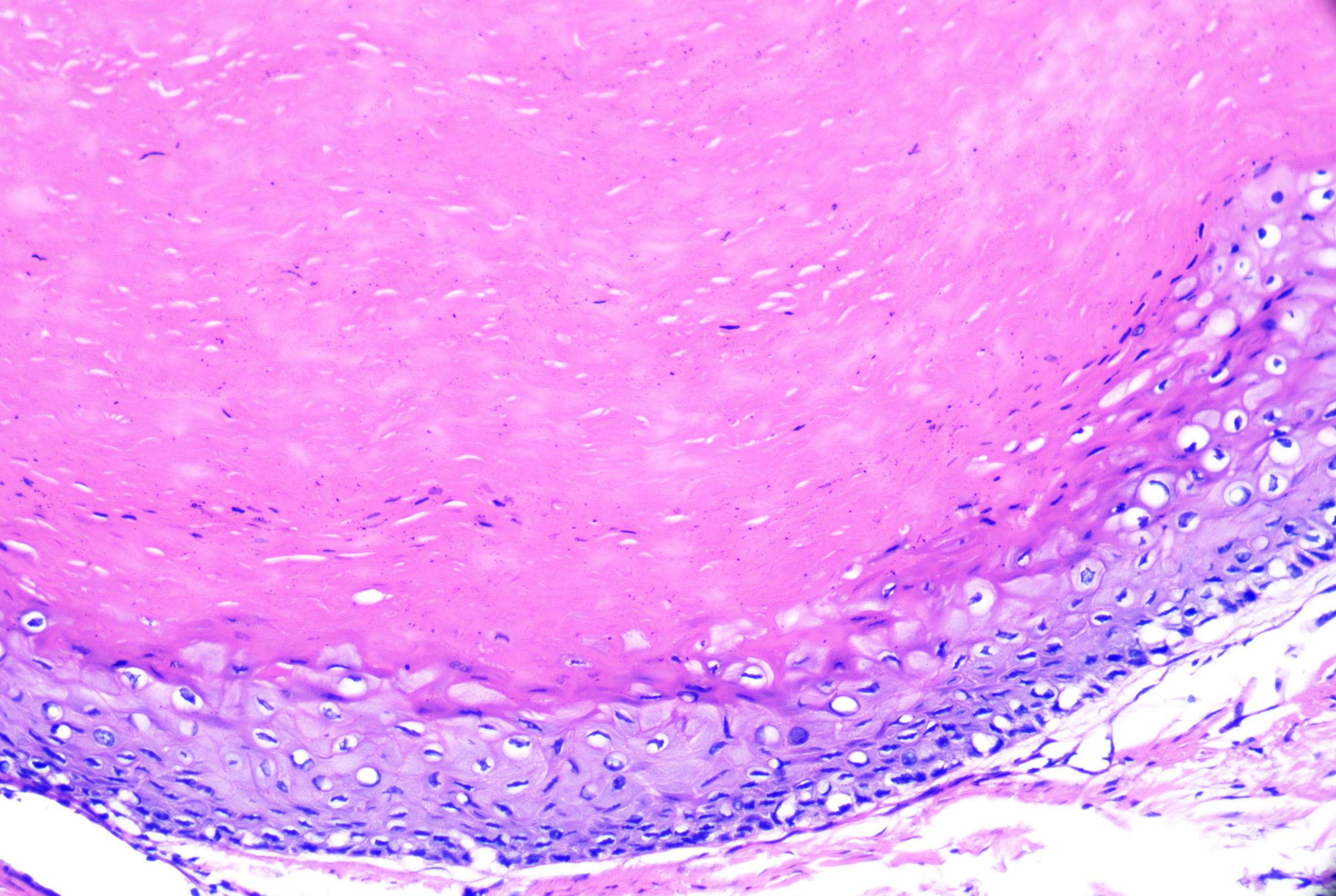 <p>Pilar Cyst Outer Root Sheath