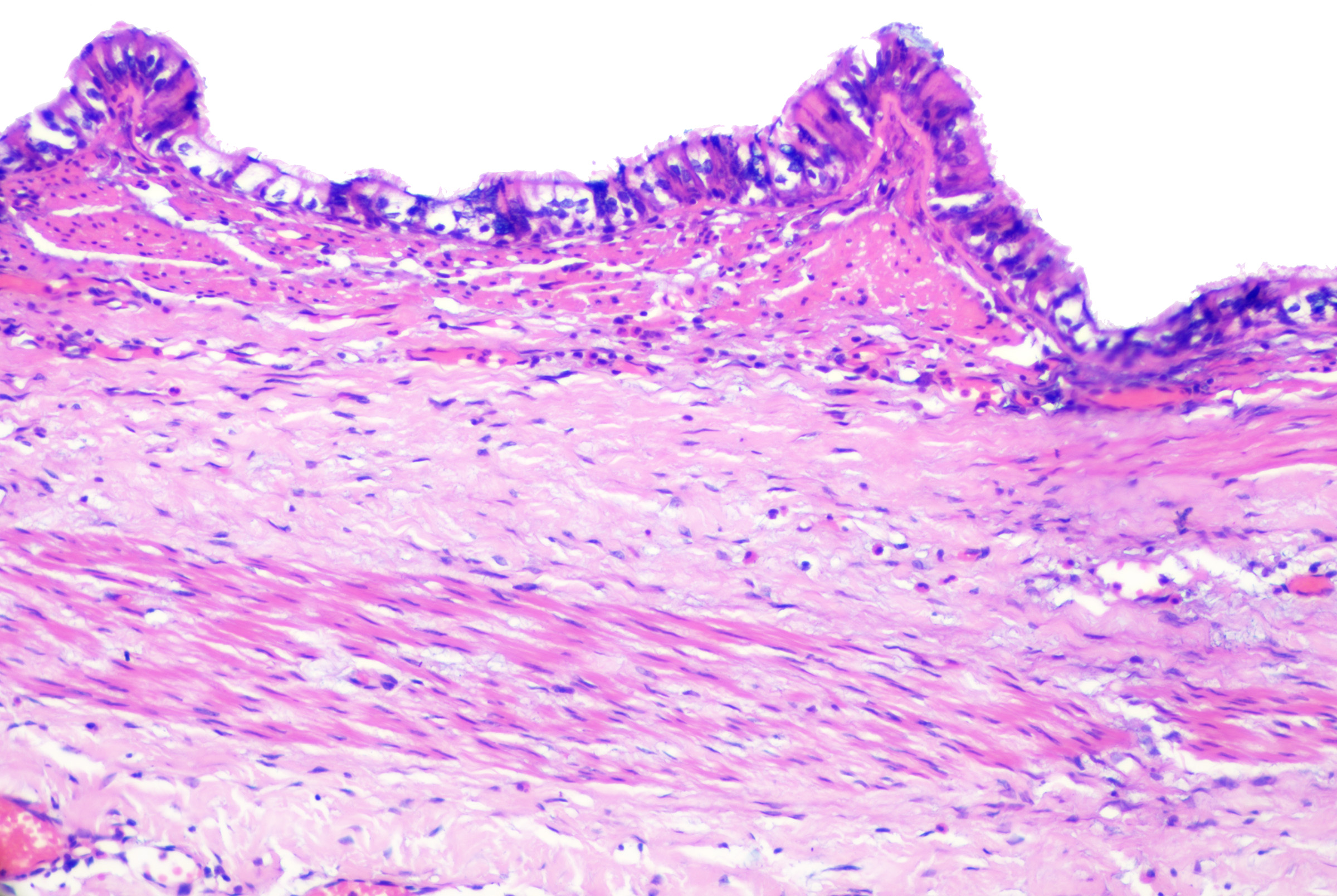 <p>Bronchogenic Cysts With Muscle and Glands