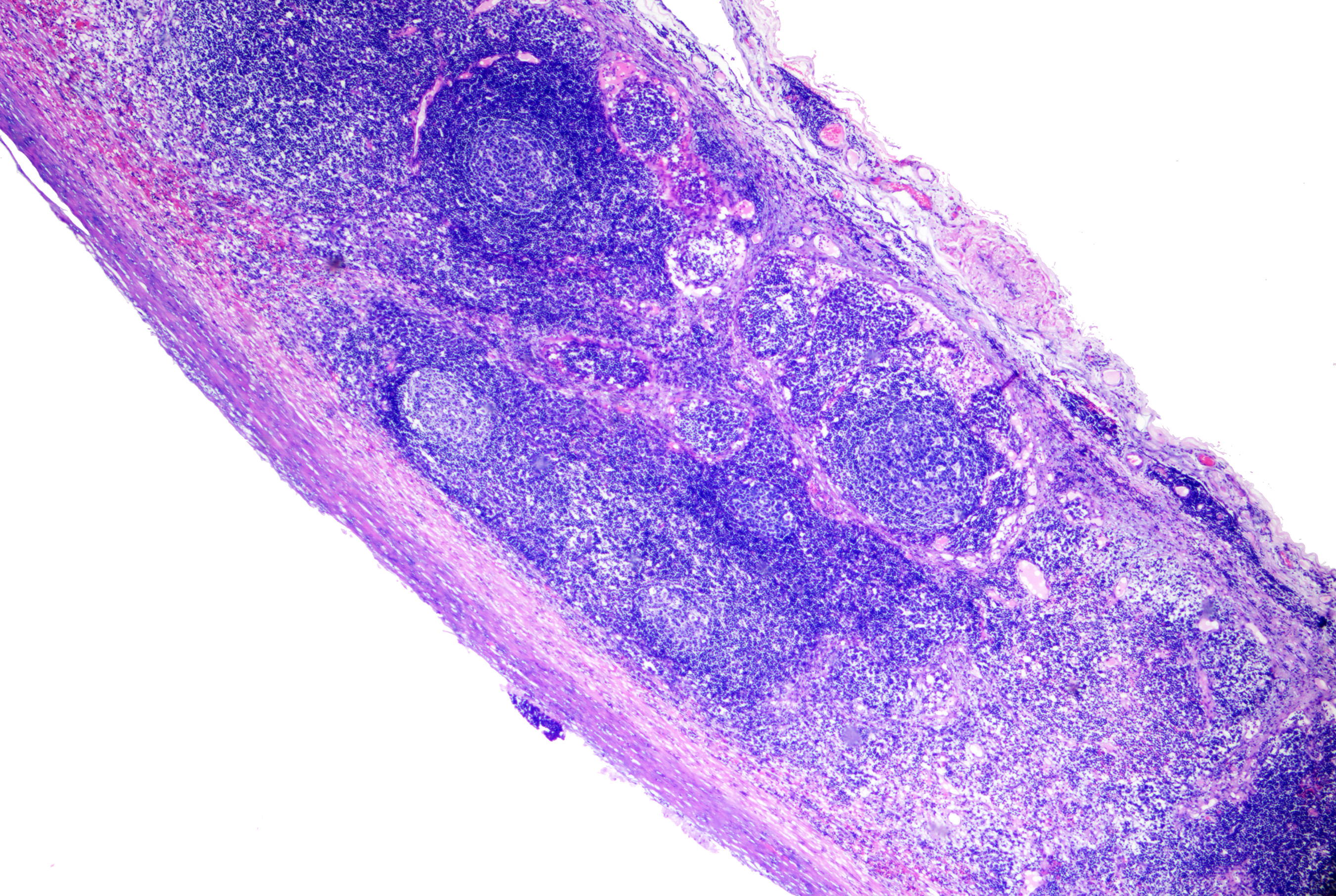 <p>Branchial Cyst. Note striking lymphoid follicle formation in the connective tissue surrounding the cyst. H&amp;E x40.</p>
