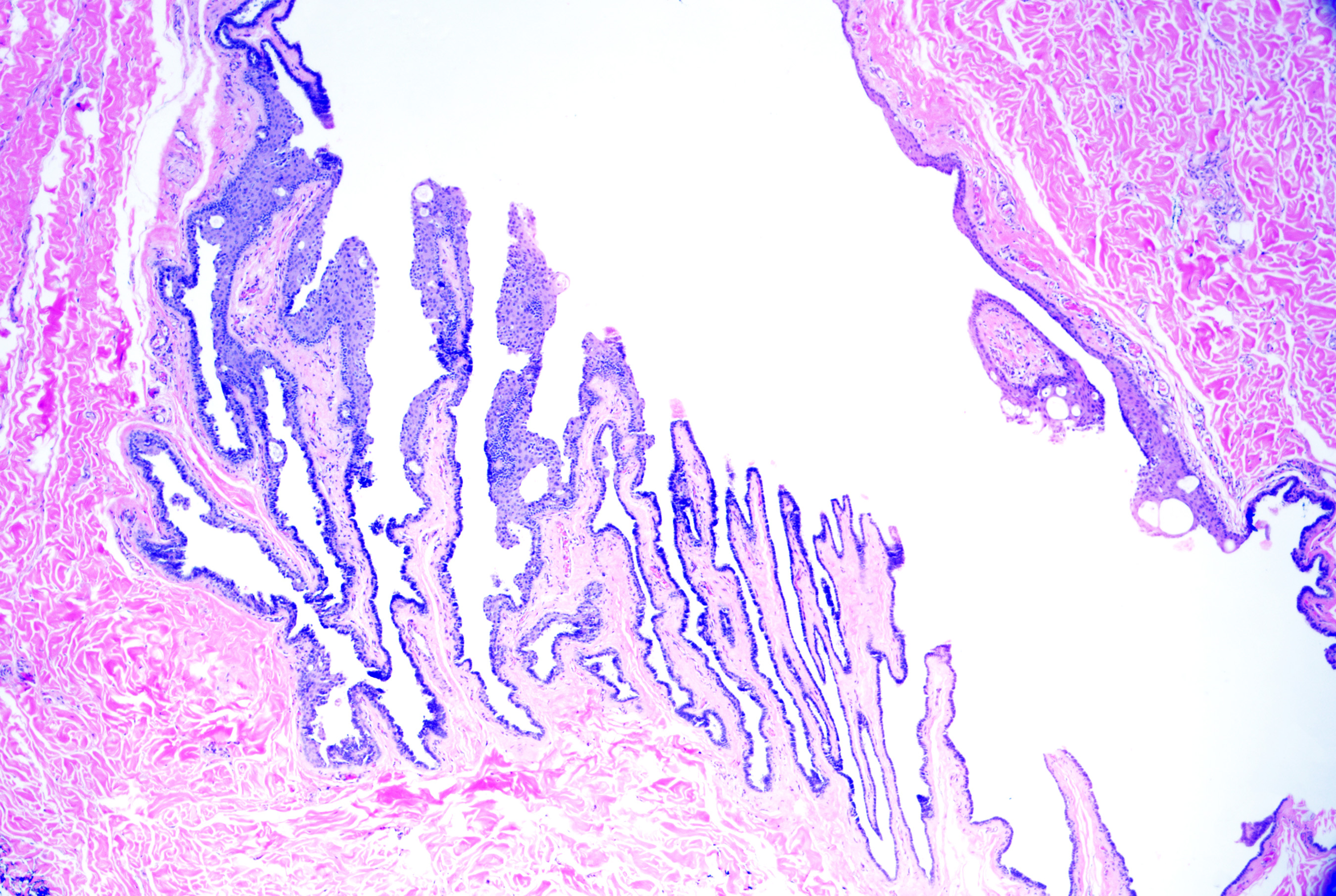<p>Cutaneous Ciliated Cyst. Note papillae formation. H&amp;E x40.</p>