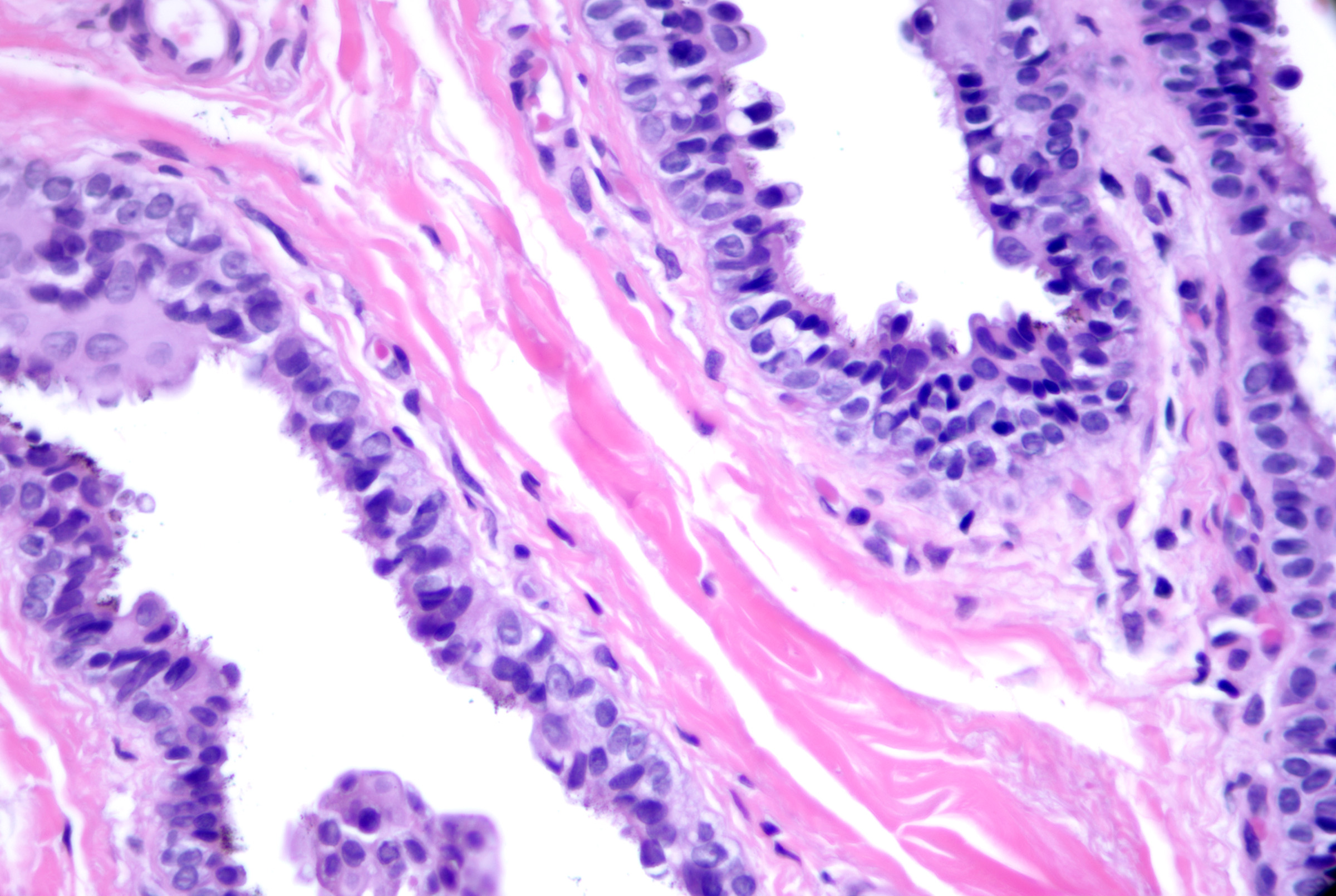 <p>Cutaneous Cyst With Epithelium