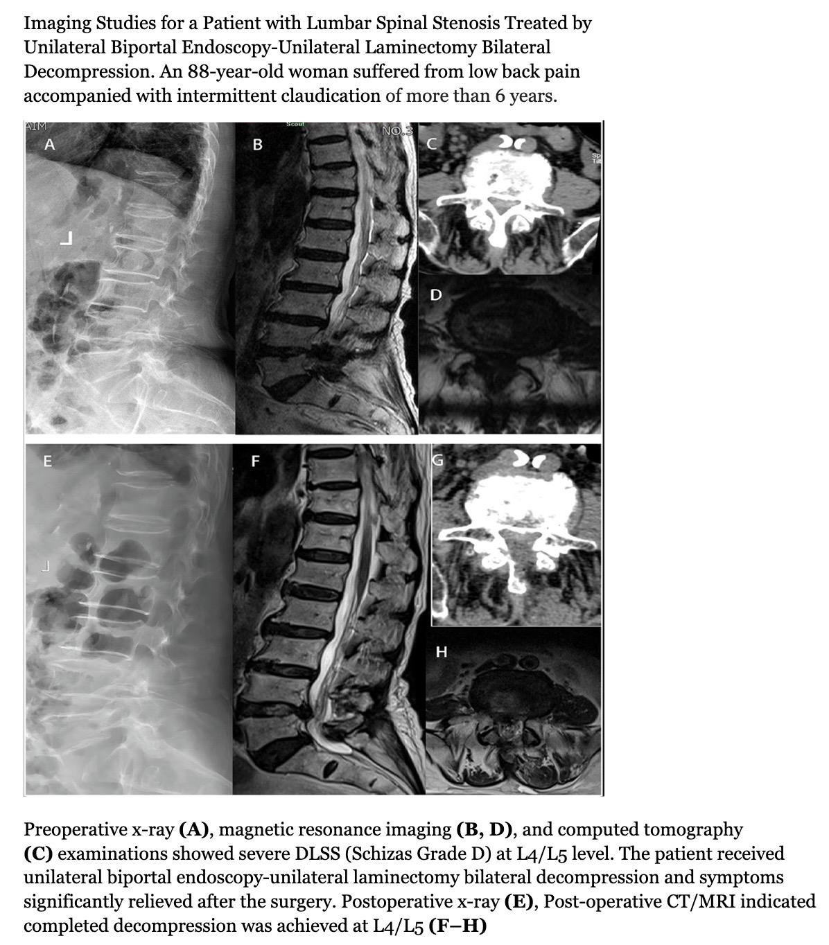 <p>Imaging Studies for a Patient with Lumbar Spinal Stenosis Treated by Unilateral Biportal Endoscopy-Unilateral Laminectomy Bilateral Decompression