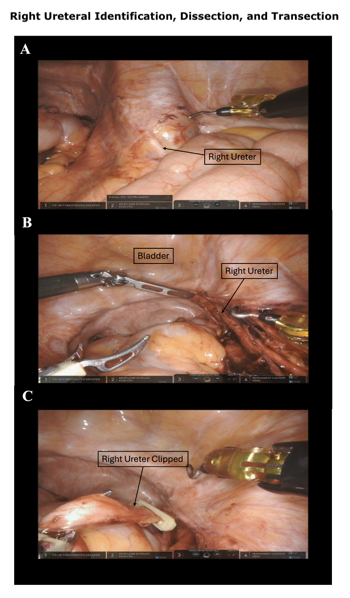 <p>Right Ureteral Identification, Dissection, and Transection</p>