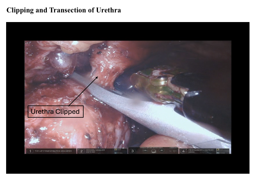 <p>Clipping and Transection of Urethra</p>