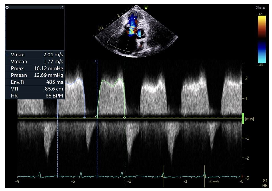 <p>Tricuspid Stenosis on Transthoracic Echocardiography</p>