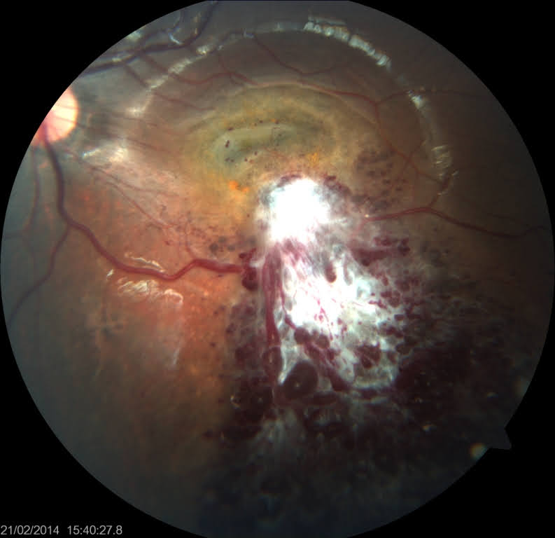 <p>Retinal Cavernous Hemangioma. The image shows grape-like vascular lesions.</p>