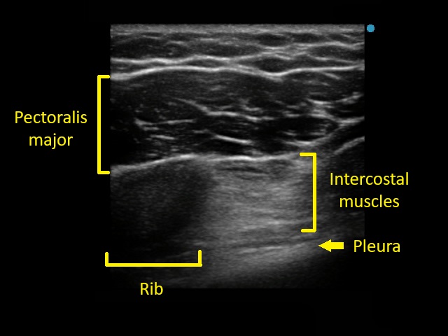 <p>Ultrasound View. Labeled ultrasound view visualized during a pecto-intercostal fascial plane block.</p>