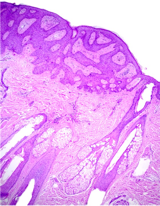 <p>Trichilemmoma Histopathological Analysis