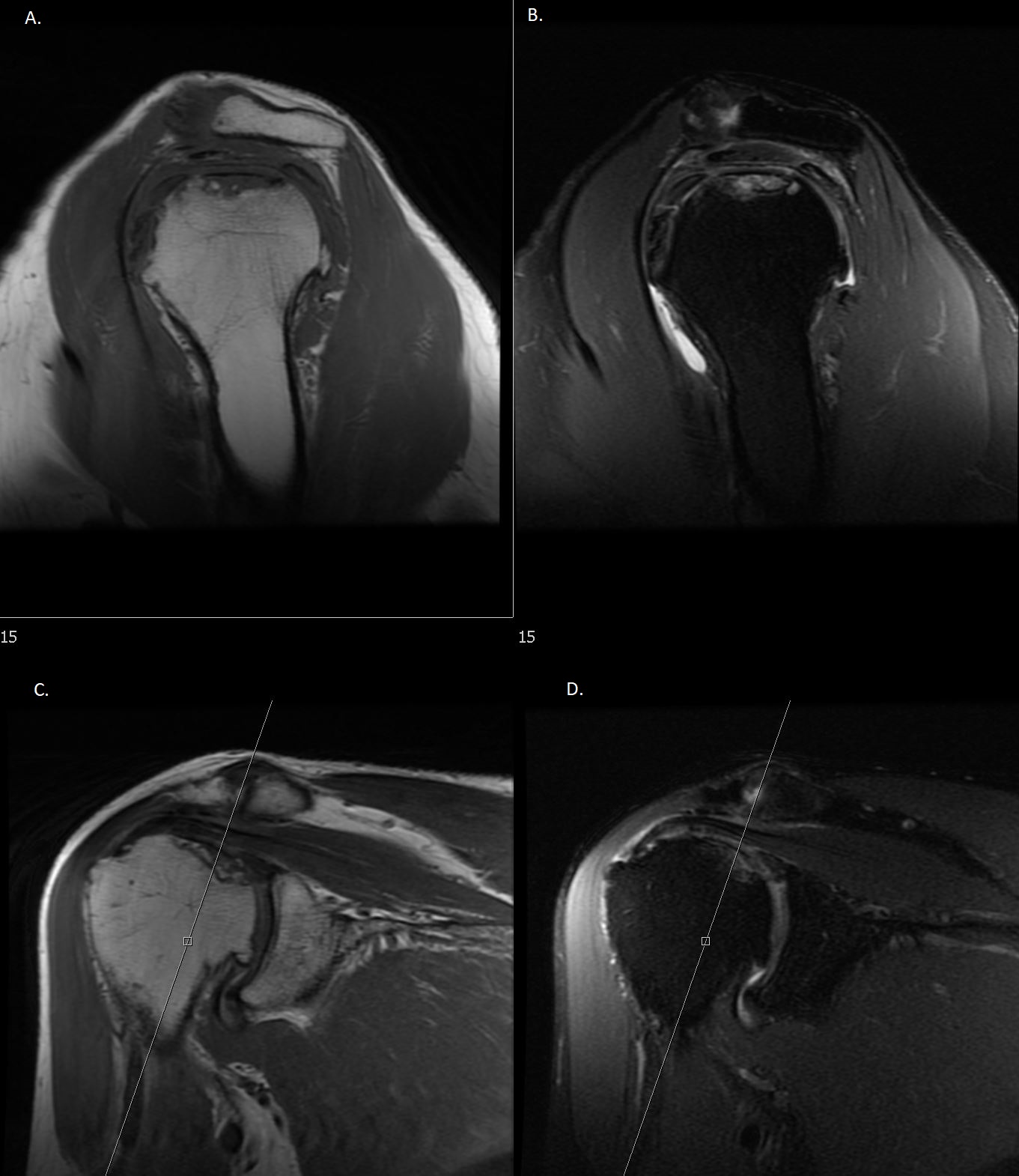 <p>MRI findings of Double-Line Sign with Subchondral Collapse