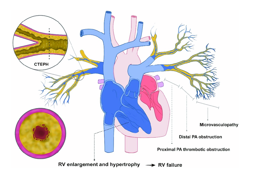 <p>Chronic Thromboembolic Pulmonary Hypertension Proposed Pathophysiology