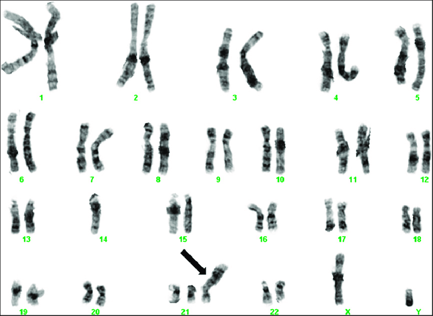 <p>Trisomy 21 on G-Banded Chromosome Studies