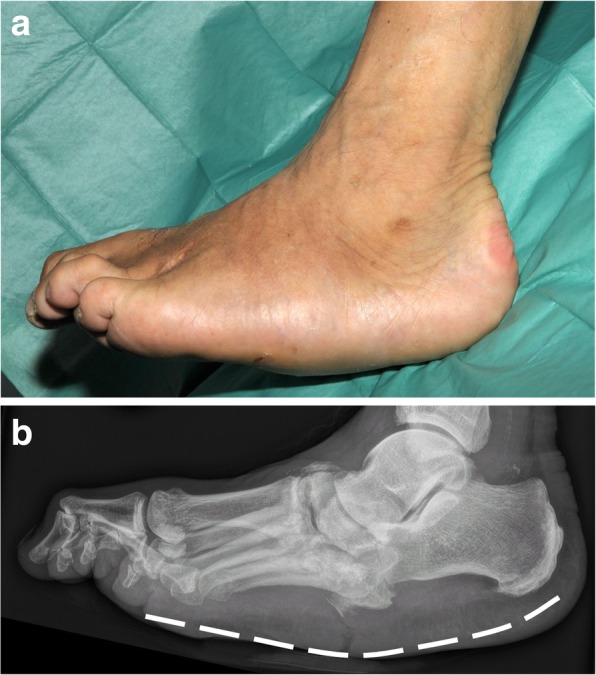 <p>Charcot Arthropathy.&nbsp;Charcot arthropathy as seen on physical examination (A) and radiography (B).</p>