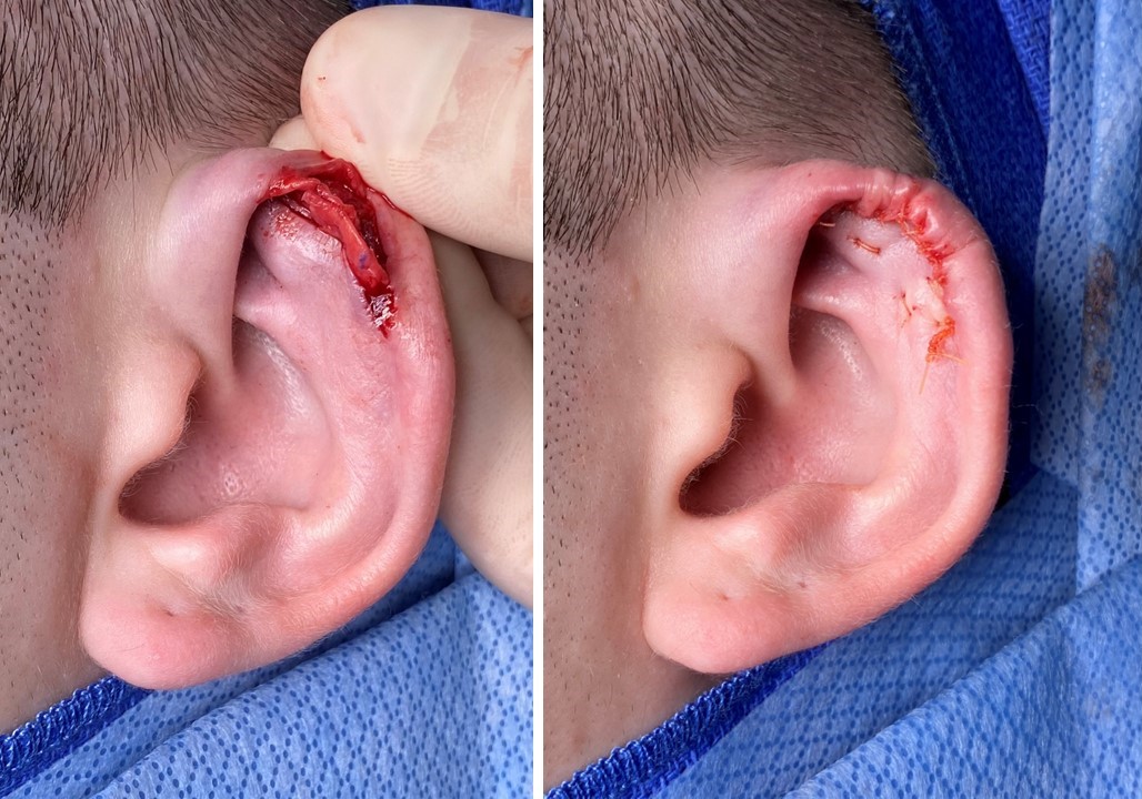 <p>Incision and Drainage of an Auricular Hematoma