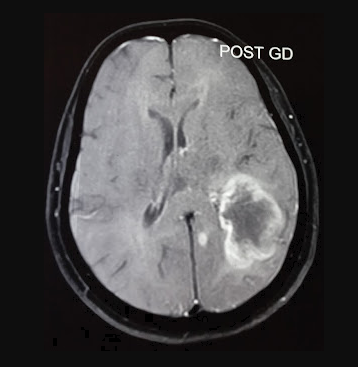 <p>Peripheral Ring Enhancement Pattern of Glioblastoma Multiforme in Contrast MRI Brain</p>
