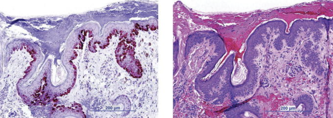 <p>Melanama-Associated Antigen Recognized by T-Cells-1 (MART-1) Staining