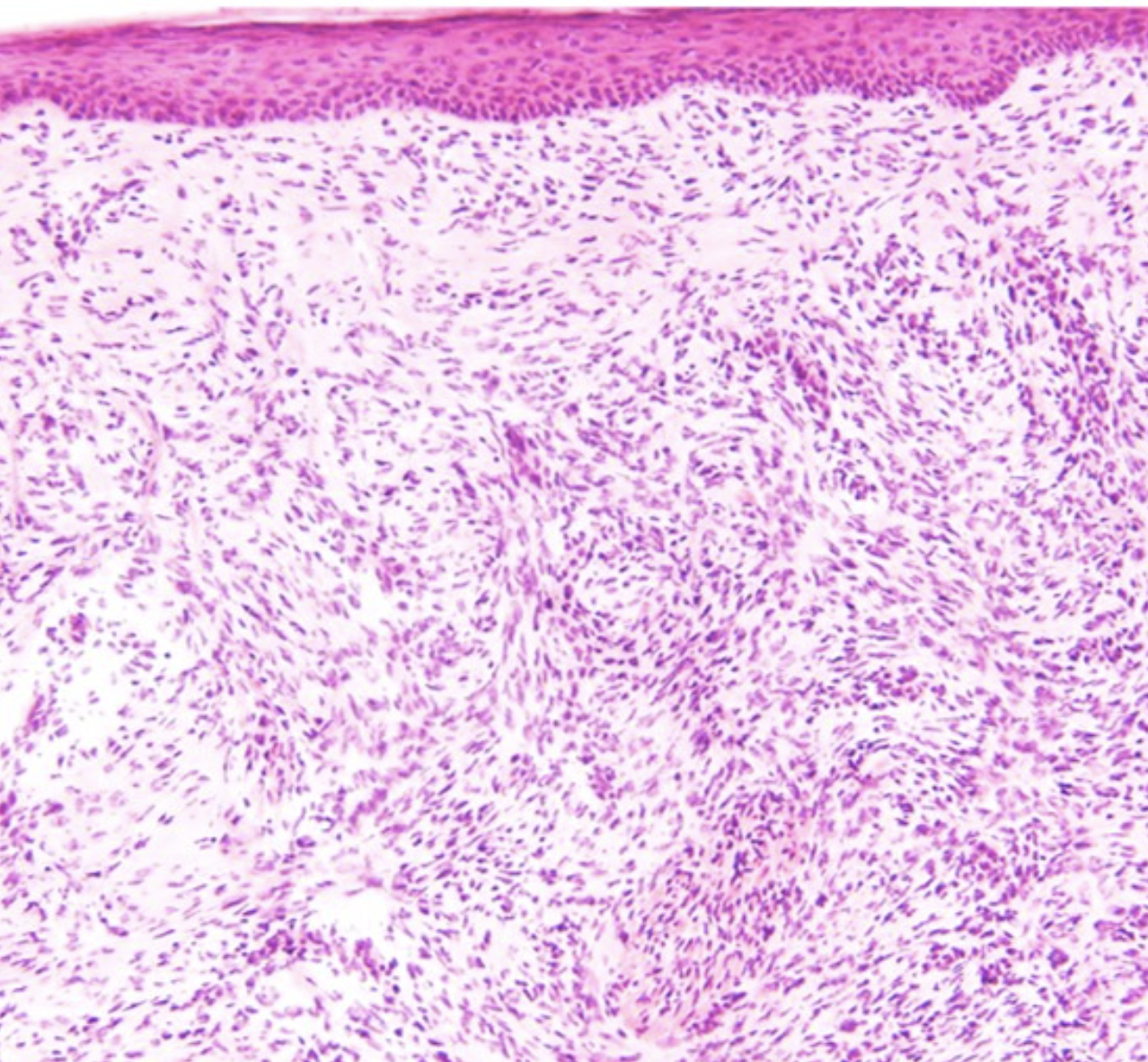 <p>Dermatofibrosarcoma Protuberans Histology