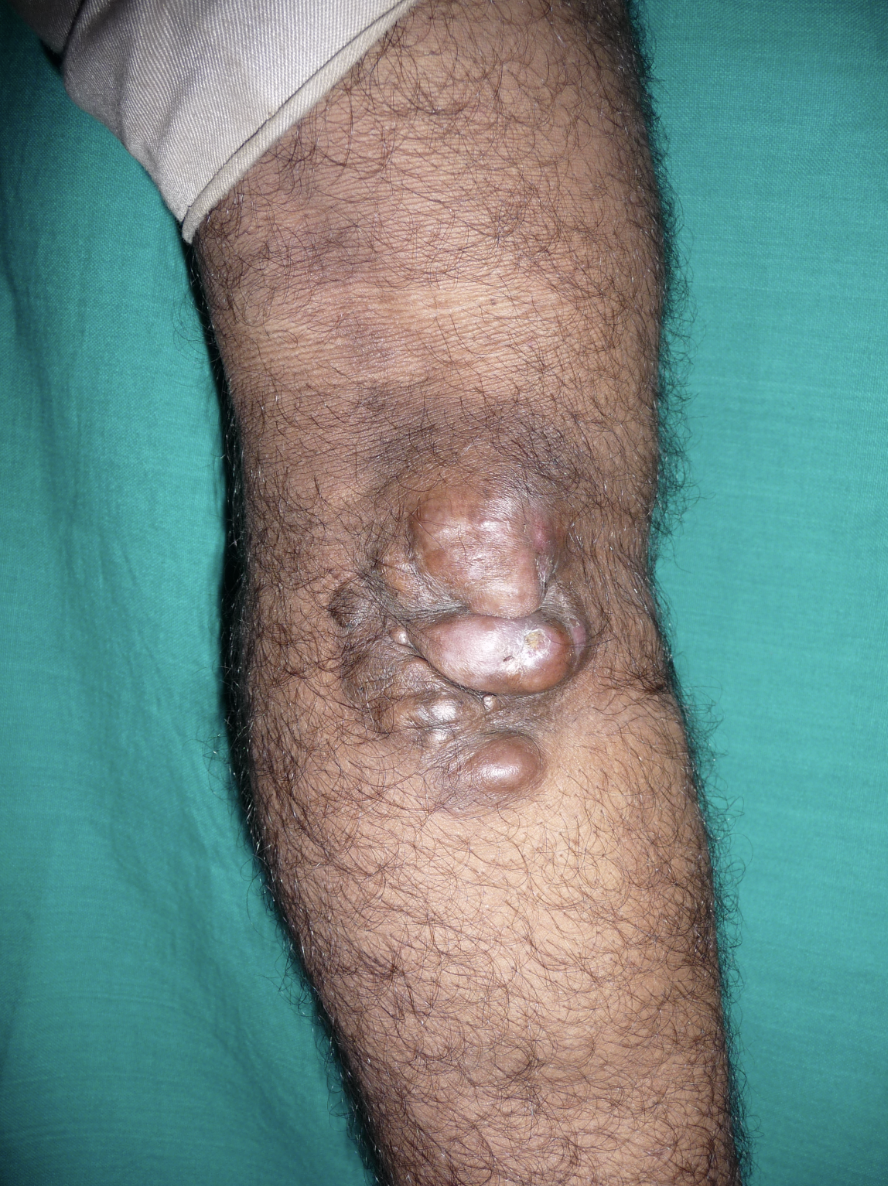 <p>Dermatofibrosarcoma Protuberans, Right Lower Extremity