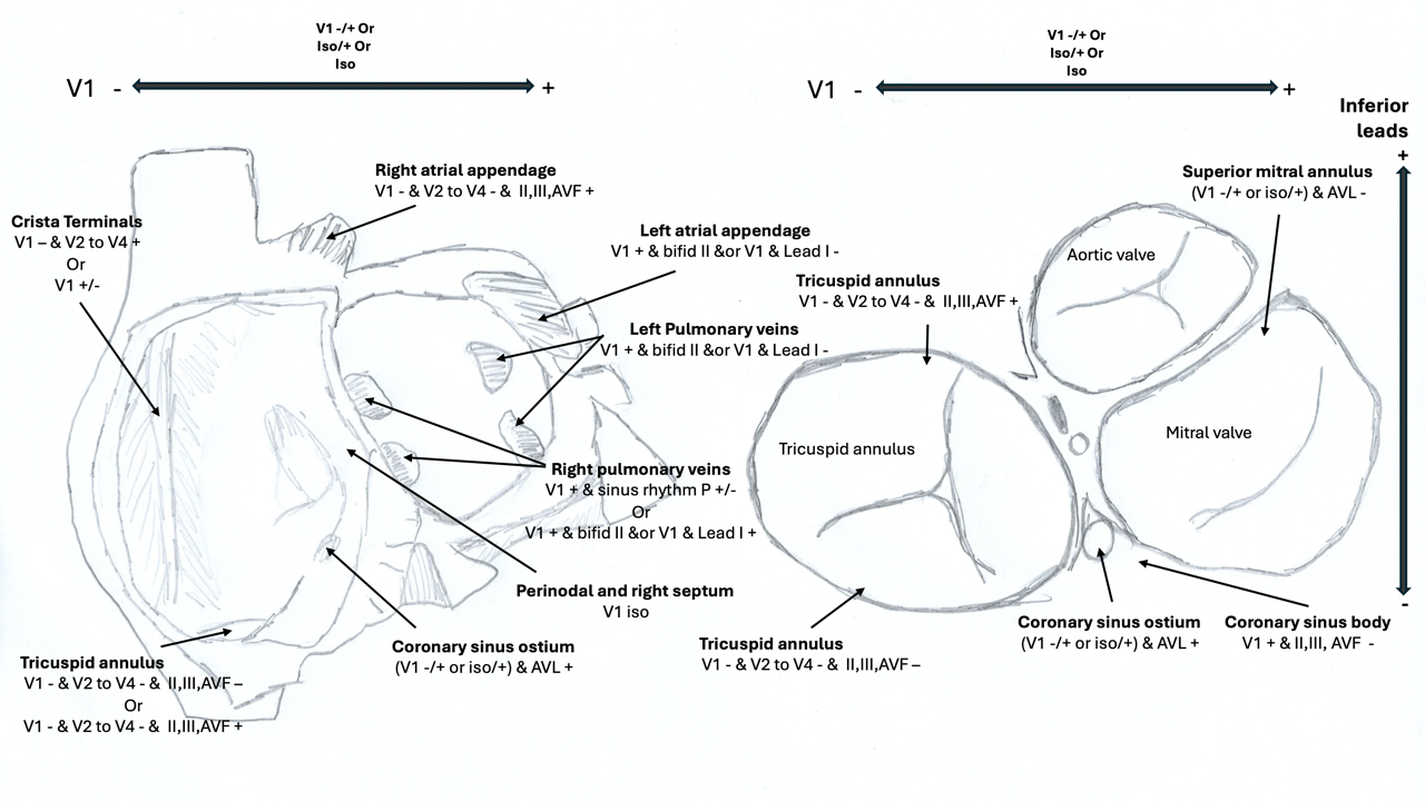 <p>Anatomical Distribution of Focal Atrial Tachycardia. This image shows the P-wave morphology in&nbsp;each region.</p>