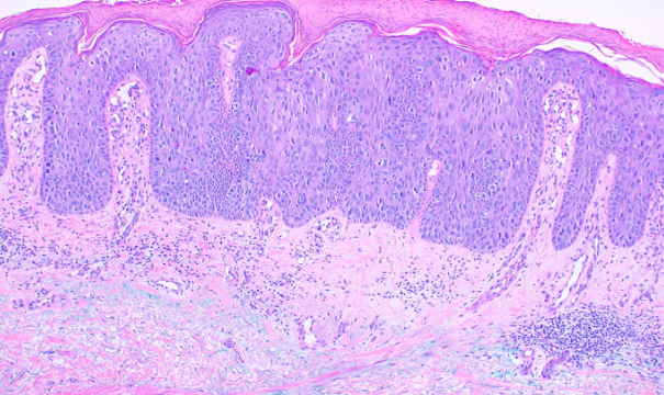 <p>Histological Slide of Squamous Cell Carcinoma, in Situ