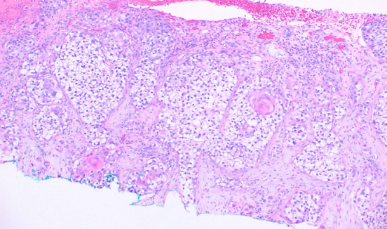 <p>Histological Slide of Squamous Cell Carcinoma, Clear Cell
