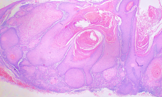<p>Histological Slide of Squamous Cell Carcinoma, Keratoacanthoma