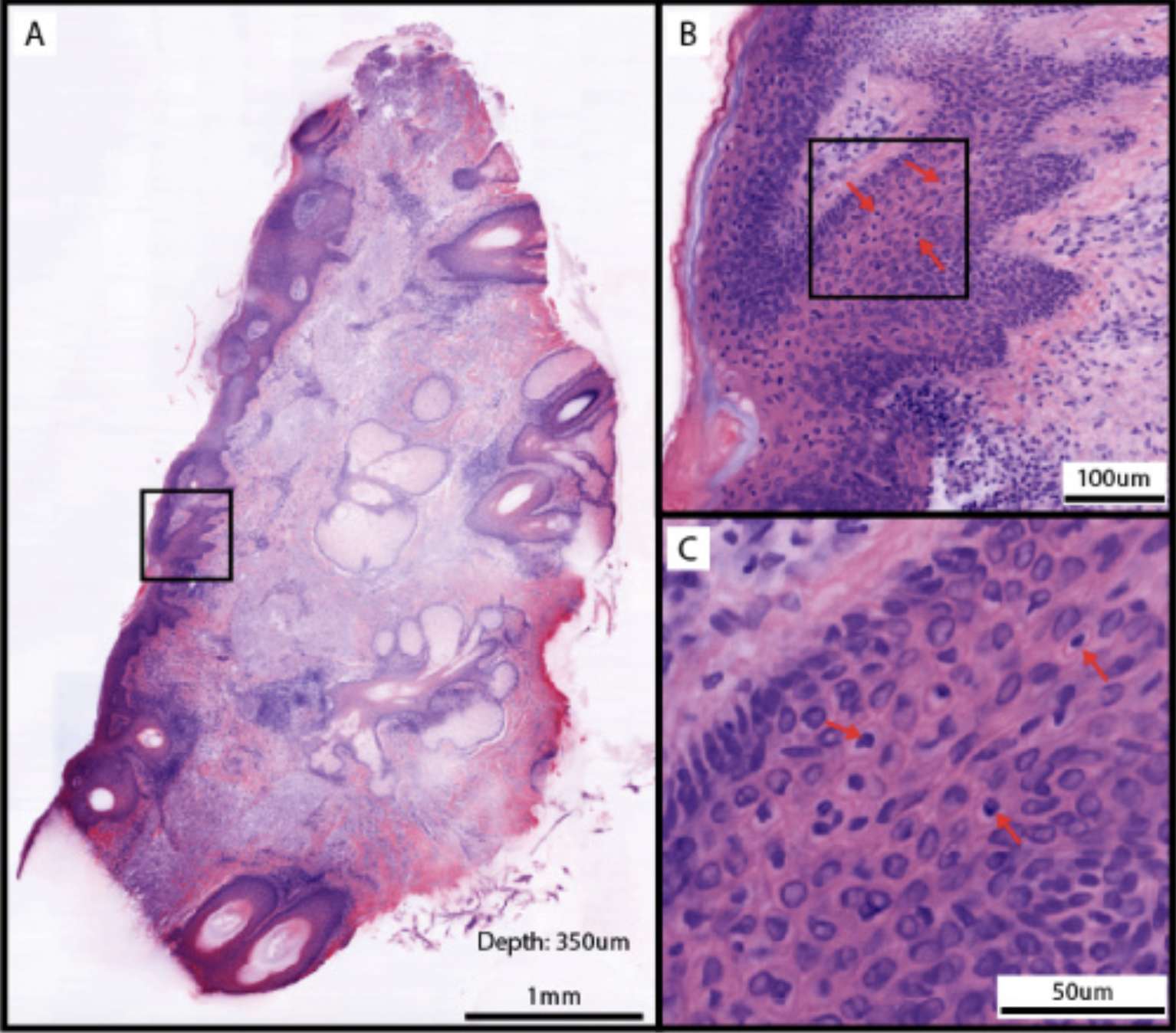 <p>Cleared Mohs Micrographic Surgical Margin