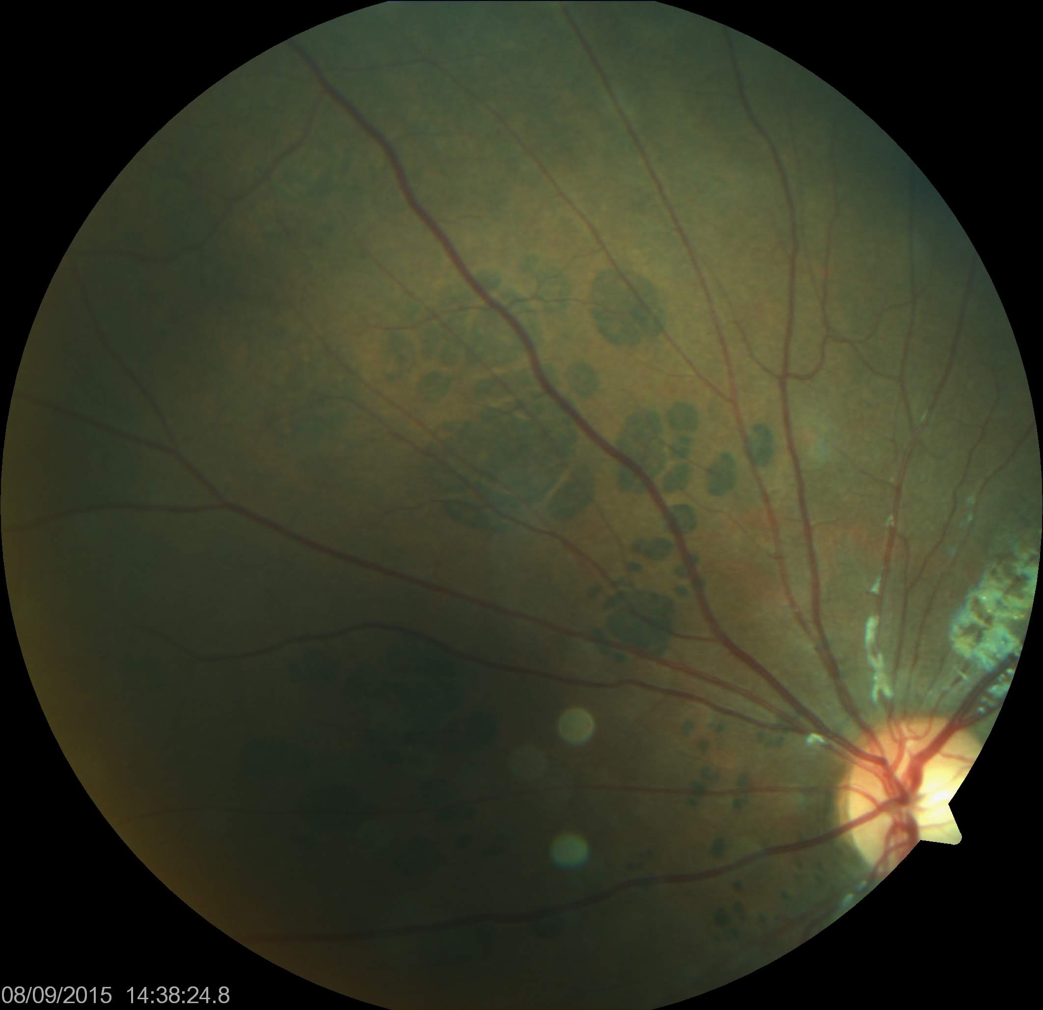 <p>Bear Track Pigmented Lesions