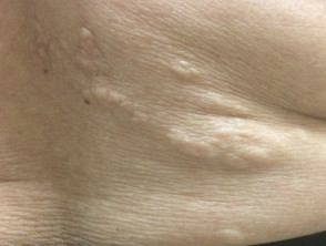 <p>Shagreen Patch of Tuberous Sclerosis