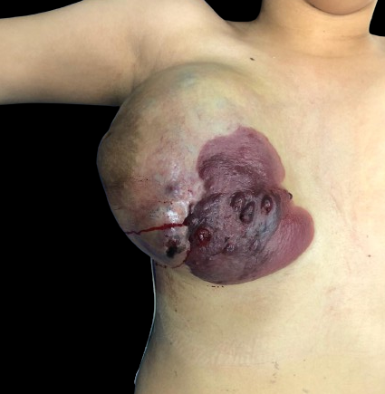 <p>Cutaneous Angiosarcoma. Angiosarcoma of the breast with cutaneous extension.&nbsp;</p>