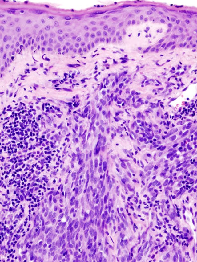 <p>Histology of Cutaneous Angiosarcoma.</p>