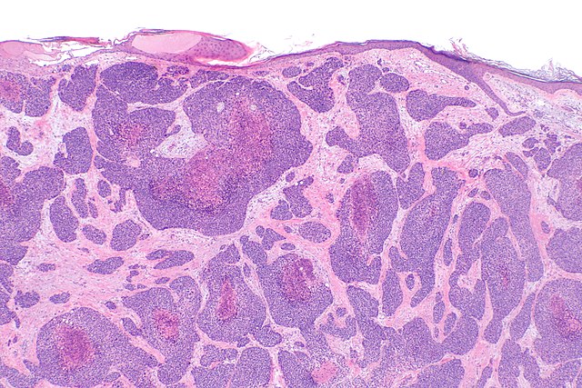 <p>Histology of Eccrine Porocarcinoma.</p>