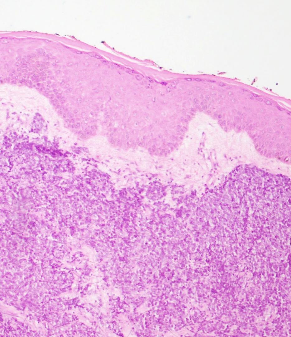 <p>Histology of Merkel Cell Carcinoma.</p>