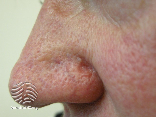 <p>Sebaceous Carcinoma, Left Nasal Ala