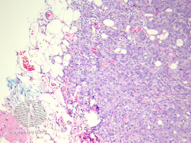 <p>Sebaceous Carcinoma, Low Power. Dermal invasion of sebaceous carcinoma cells into the subcutis.</p>