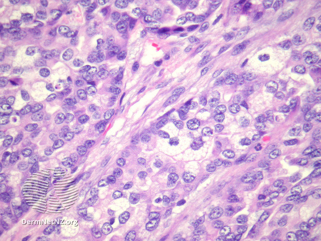 <p>Sebaceous Carcinoma, High Power. Foamy sebocytes with abundant cytoplasm showing vacuolization.</p>