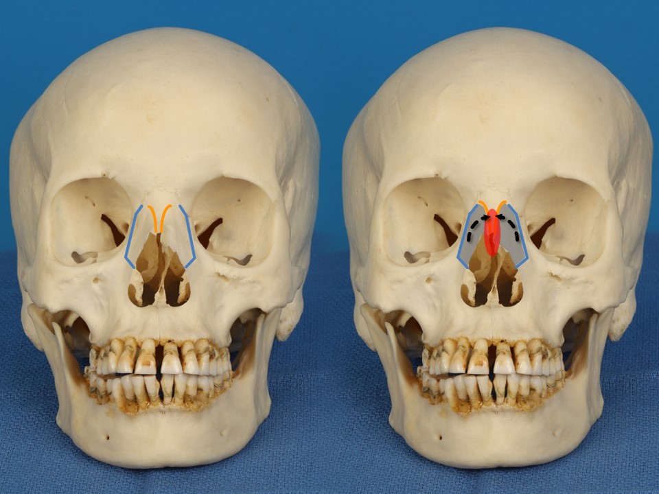 <p>Nasal osteotomies for adjusting the width of the bony vault