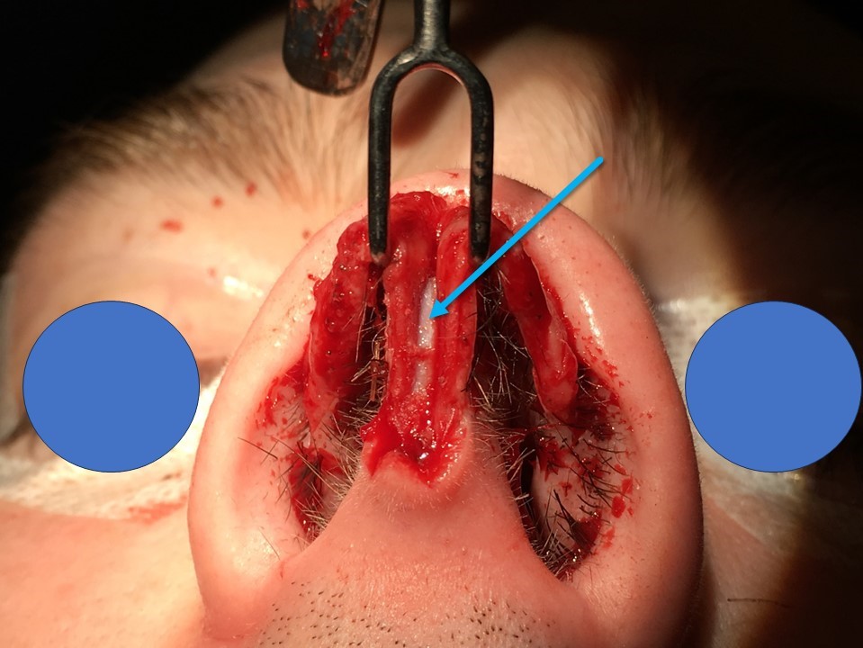 <p>A columellar strut is placed between the medial crura of the lower lateral cartilages in order to improve tip support and straighten the columella; the graft is marked with an arrow