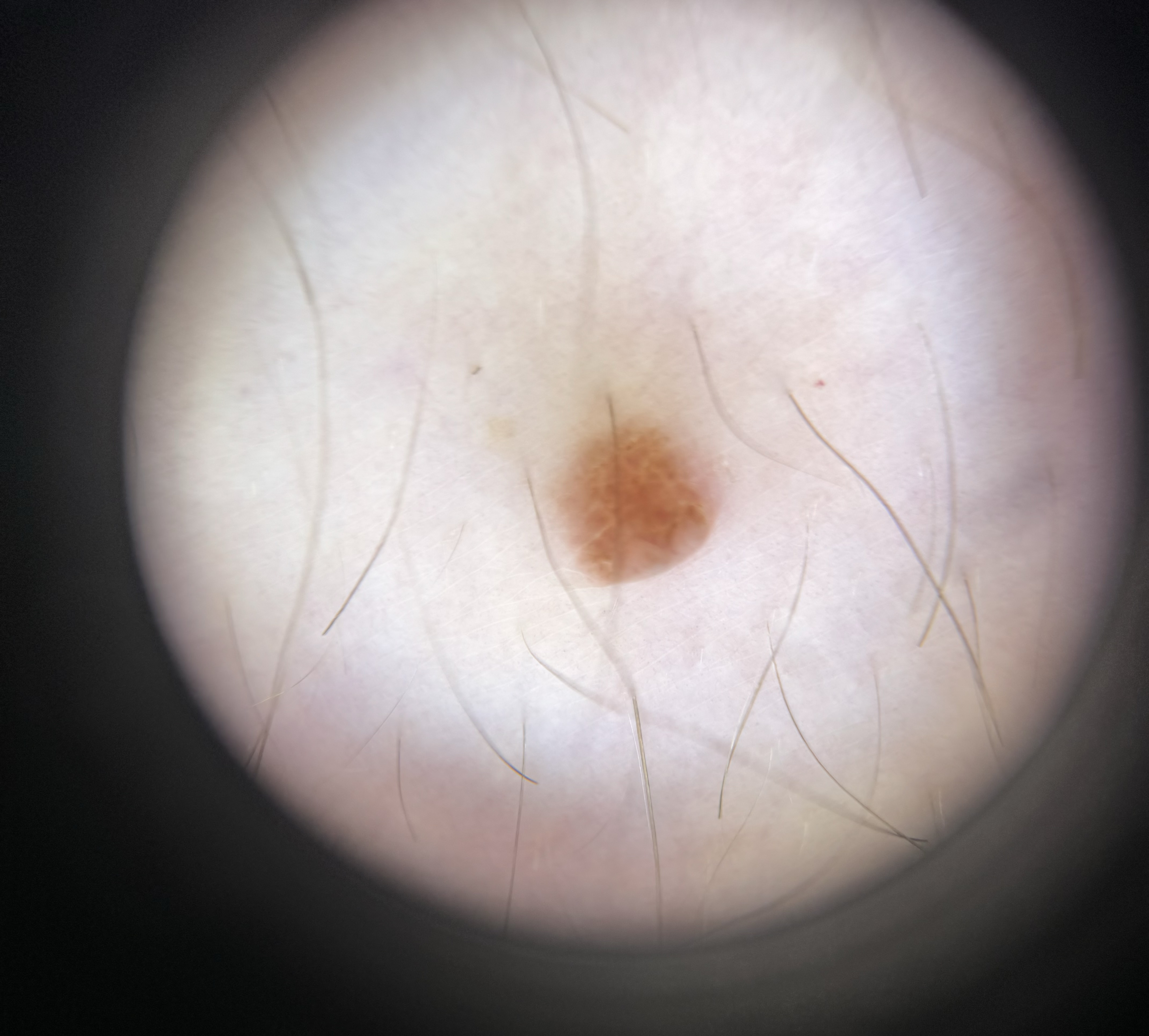 <p>Dermoscopic Image of a Benign Nevus</p>