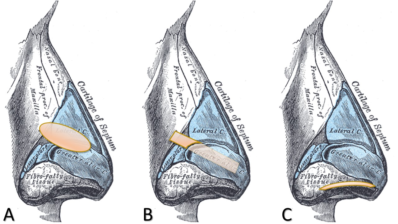 <p>Common Cartilage Grafts Employed in Rhinoplasty