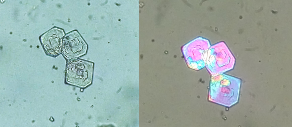 <p>Sulfamethoxazole Crystals