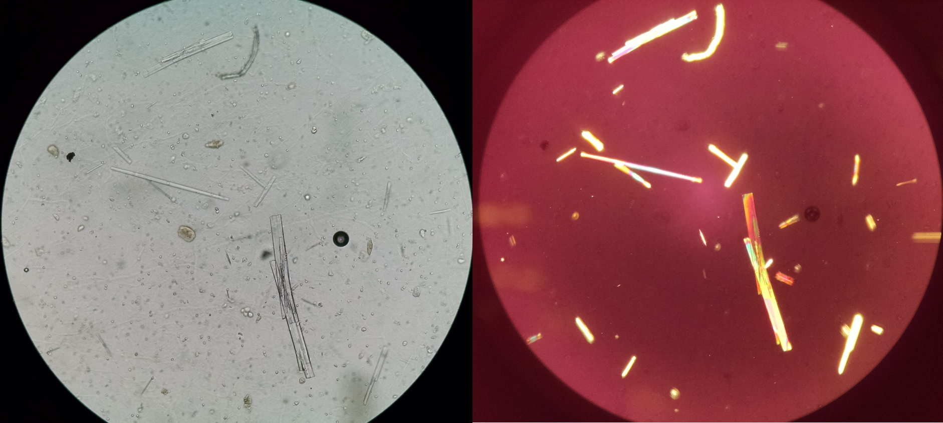 <p>Acyclovir Crystals. Left: light microscopy unstained;&nbsp;right: polarized light with birefringence.</p>